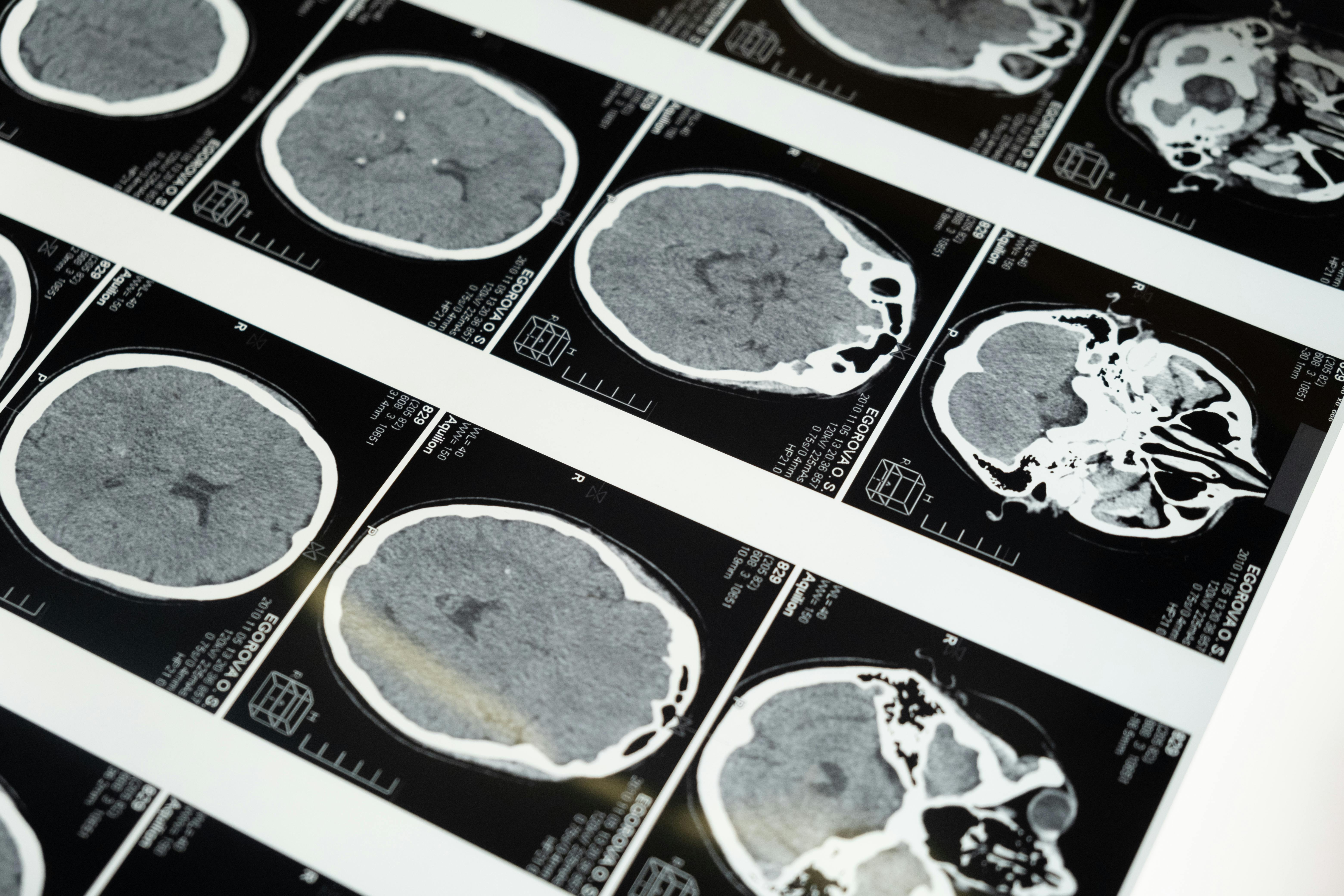 Brain MRI scans displayed on lightbox